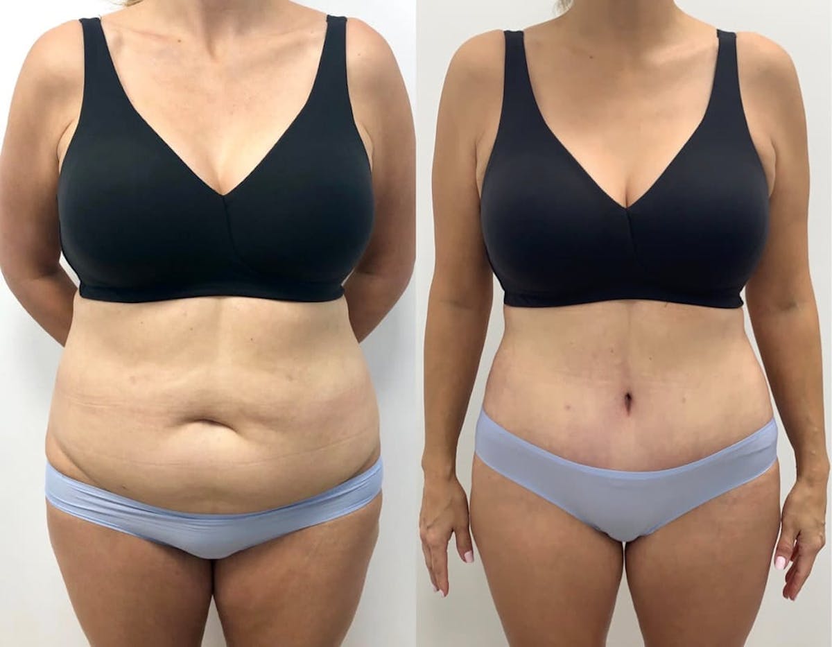 Tummy Tuck Before & After Gallery - Patient 344549 - Image 1