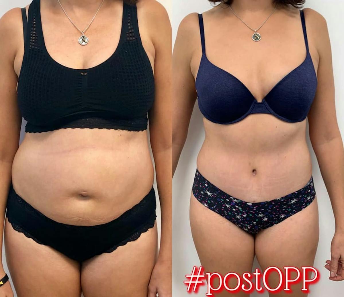 Tummy Tuck Before & After Gallery - Patient 370440 - Image 1