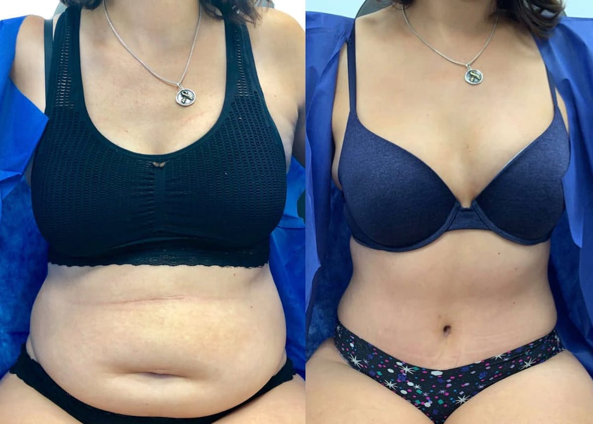 Tummy Tuck Before & After Gallery - Patient 370440 - Image 2