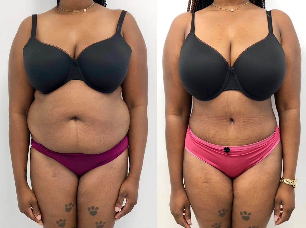 Tummy Tuck Before & After Gallery - Patient 269256 - Image 1