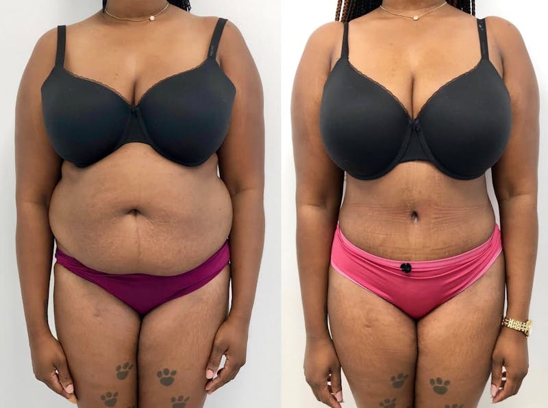 Tummy Tuck Before & After Gallery - Patient 269256 - Image 1