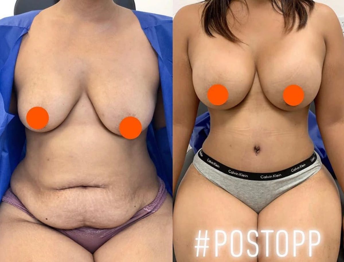 Tummy Tuck Before & After Gallery - Patient 267559 - Image 1