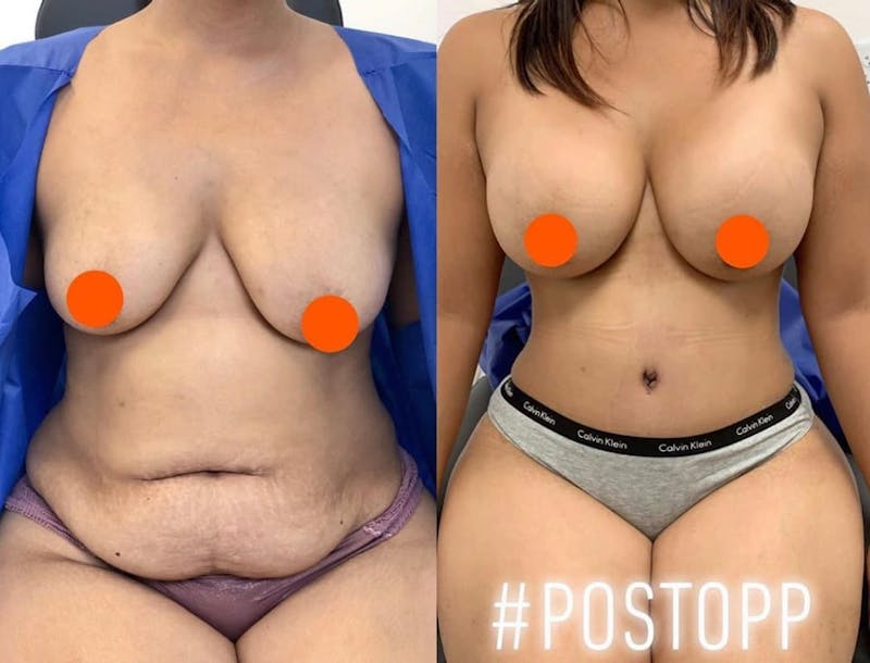 Tummy Tuck Before & After Gallery - Patient 267559 - Image 1