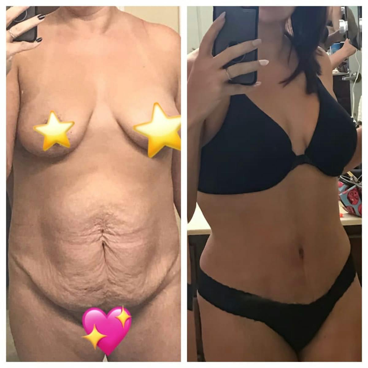 Tummy Tuck Before & After Gallery - Patient 422500 - Image 1