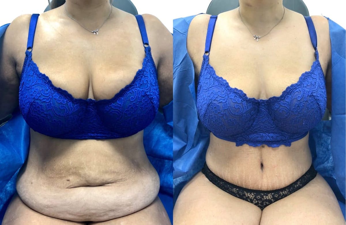 Tummy Tuck Before & After Gallery - Patient 331867 - Image 1