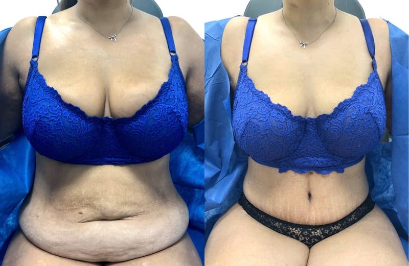 Tummy Tuck Before & After Gallery - Patient 331867 - Image 1
