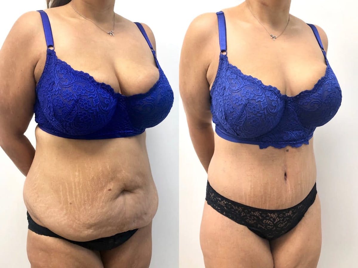Tummy Tuck Before & After Gallery - Patient 331867 - Image 2
