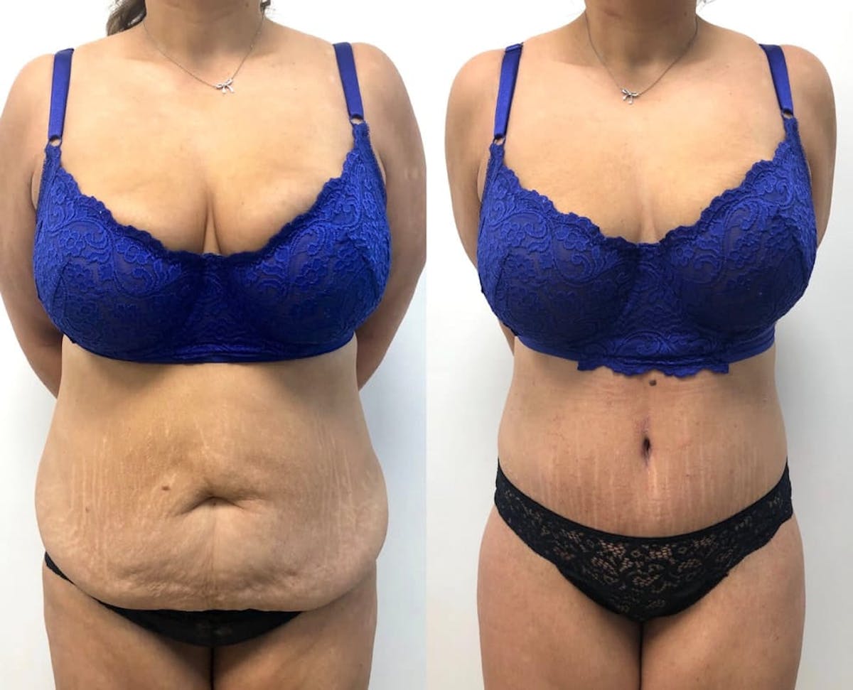 Tummy Tuck Before & After Gallery - Patient 331867 - Image 3