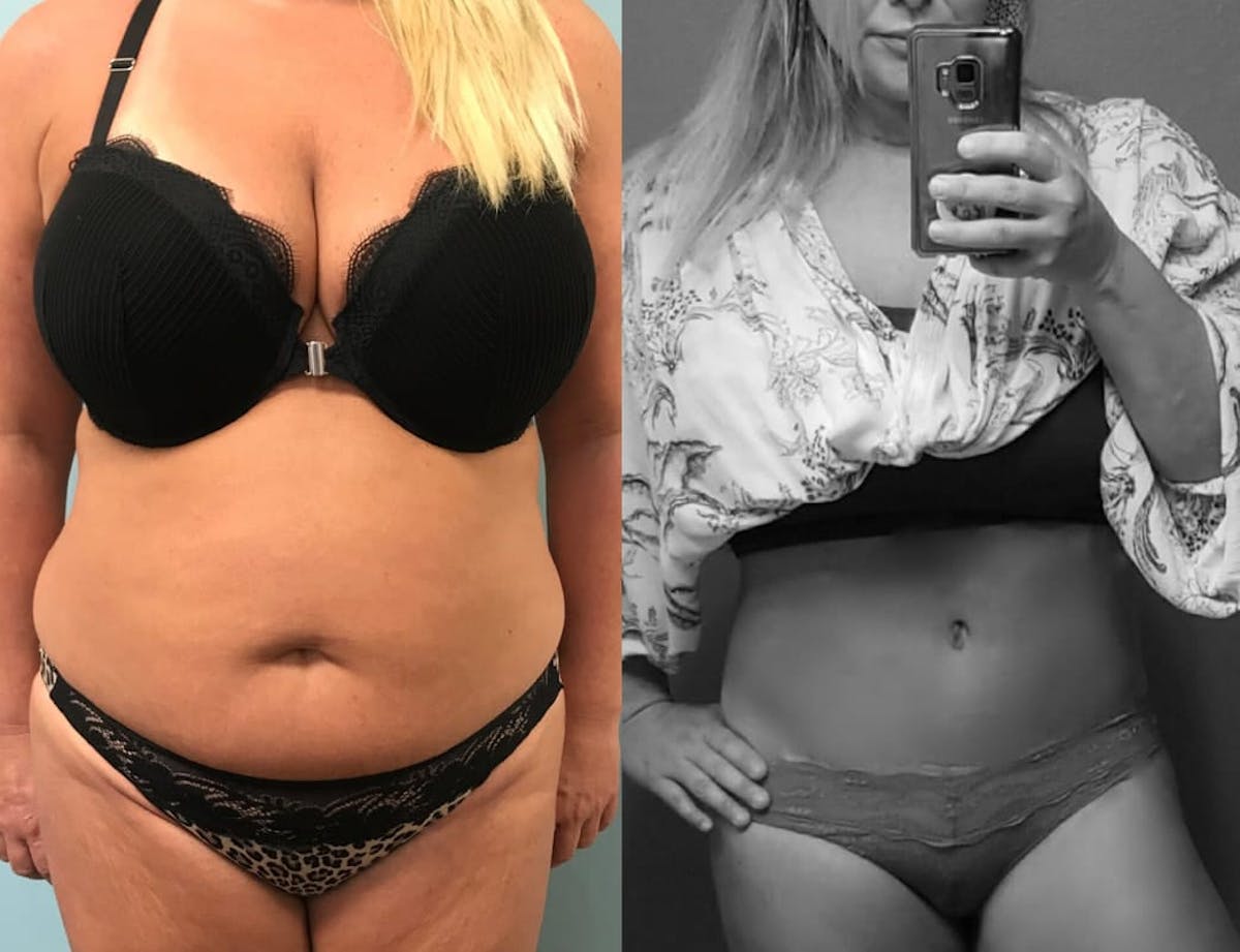 Tummy Tuck Before & After Gallery - Patient 108171 - Image 1