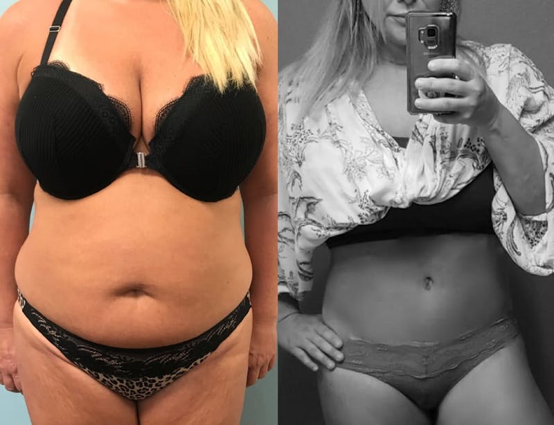 Tummy Tuck Before & After Gallery - Patient 108171 - Image 1
