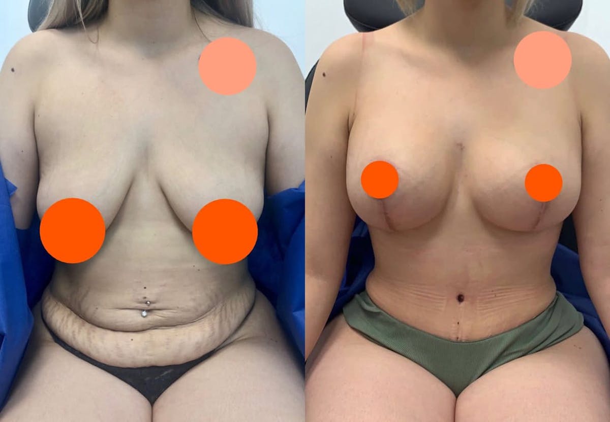 Tummy Tuck Before & After Gallery - Patient 311687 - Image 1