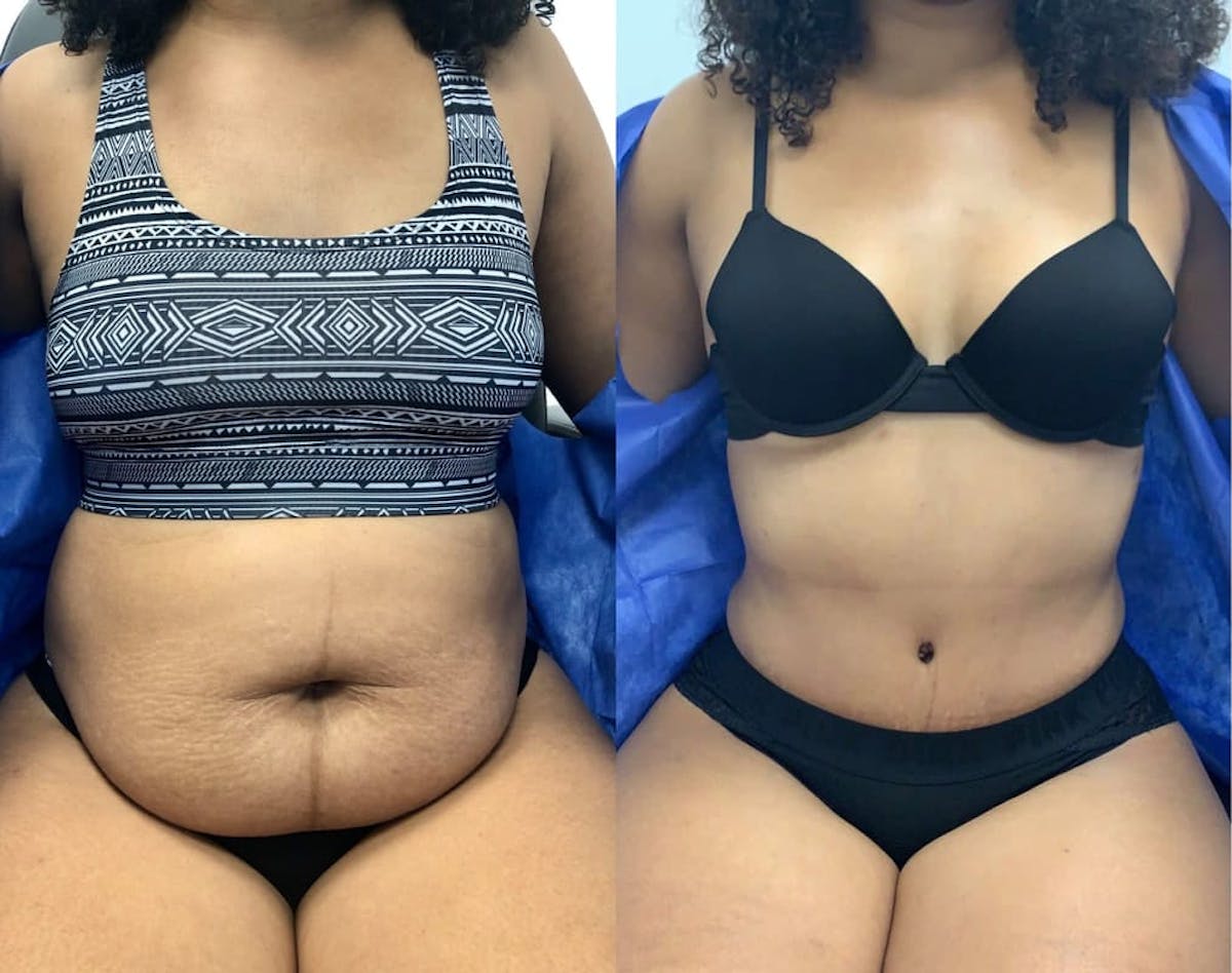 Tummy Tuck Before & After Gallery - Patient 202654 - Image 1