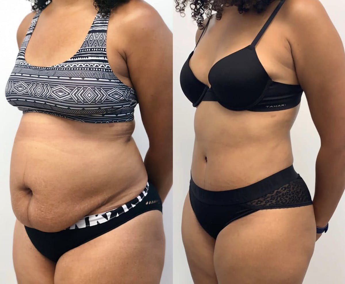 Tummy Tuck Before & After Gallery - Patient 202654 - Image 2