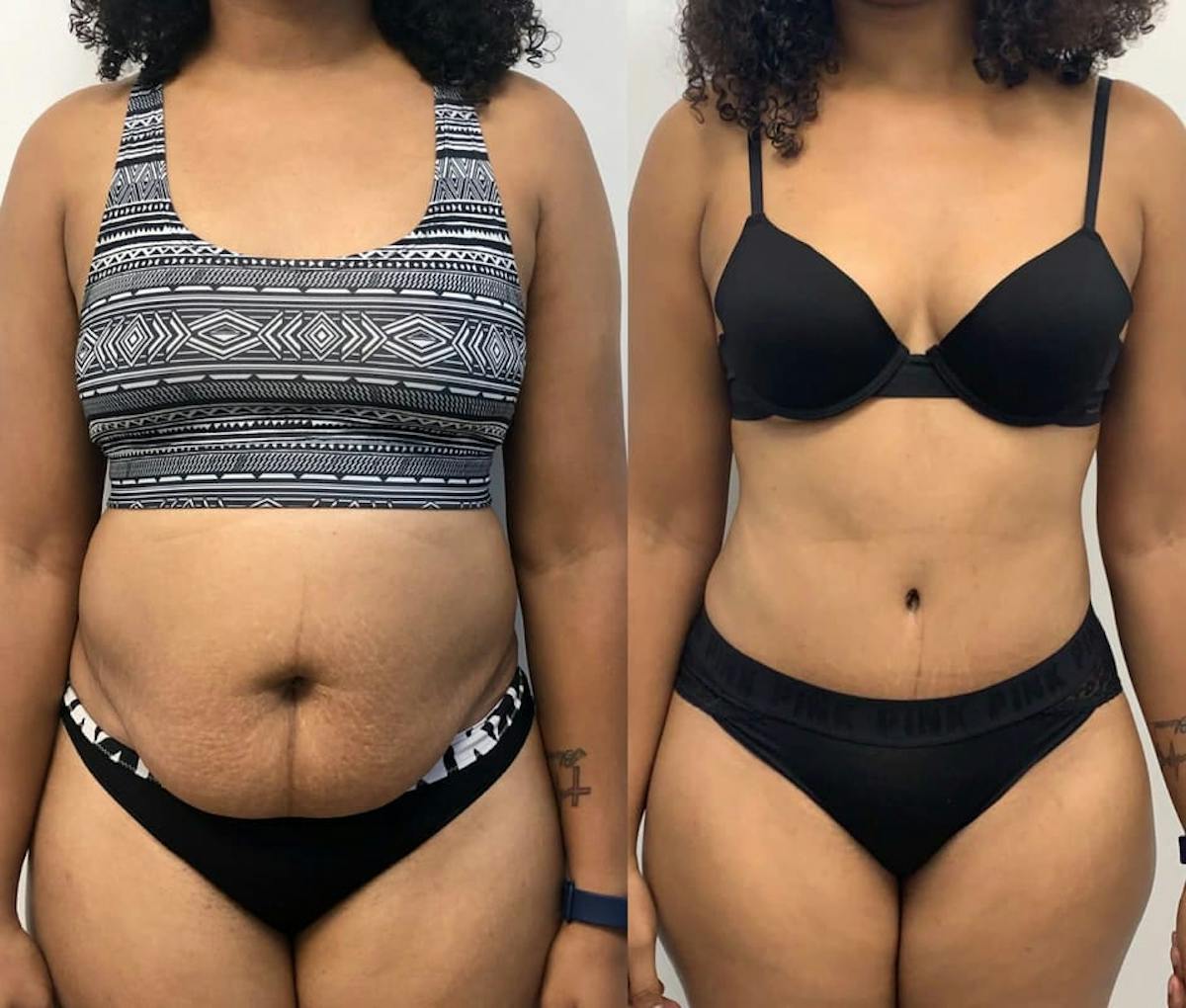 Tummy Tuck Before & After Gallery - Patient 202654 - Image 4