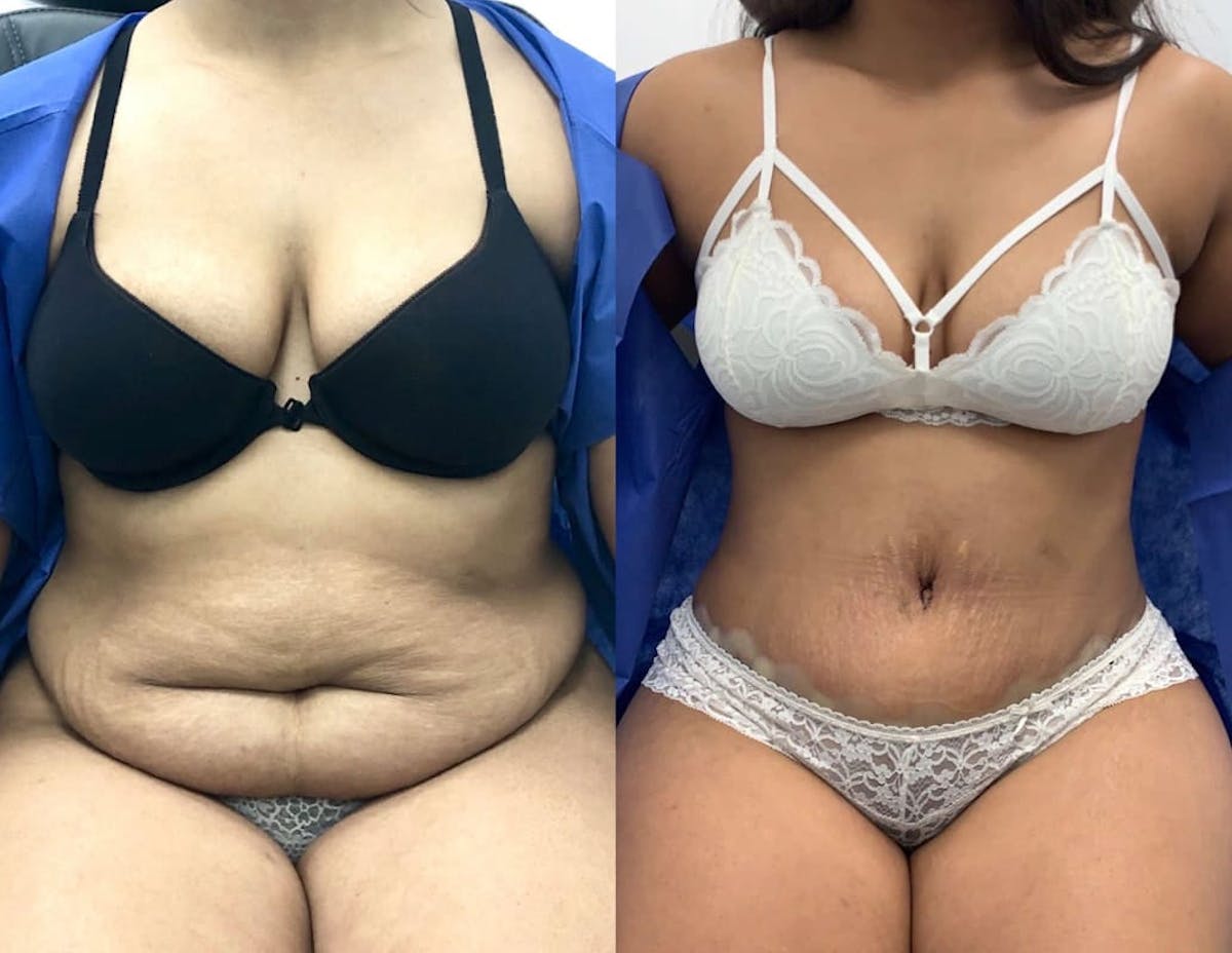 Tummy Tuck Before & After Gallery - Patient 185427 - Image 1