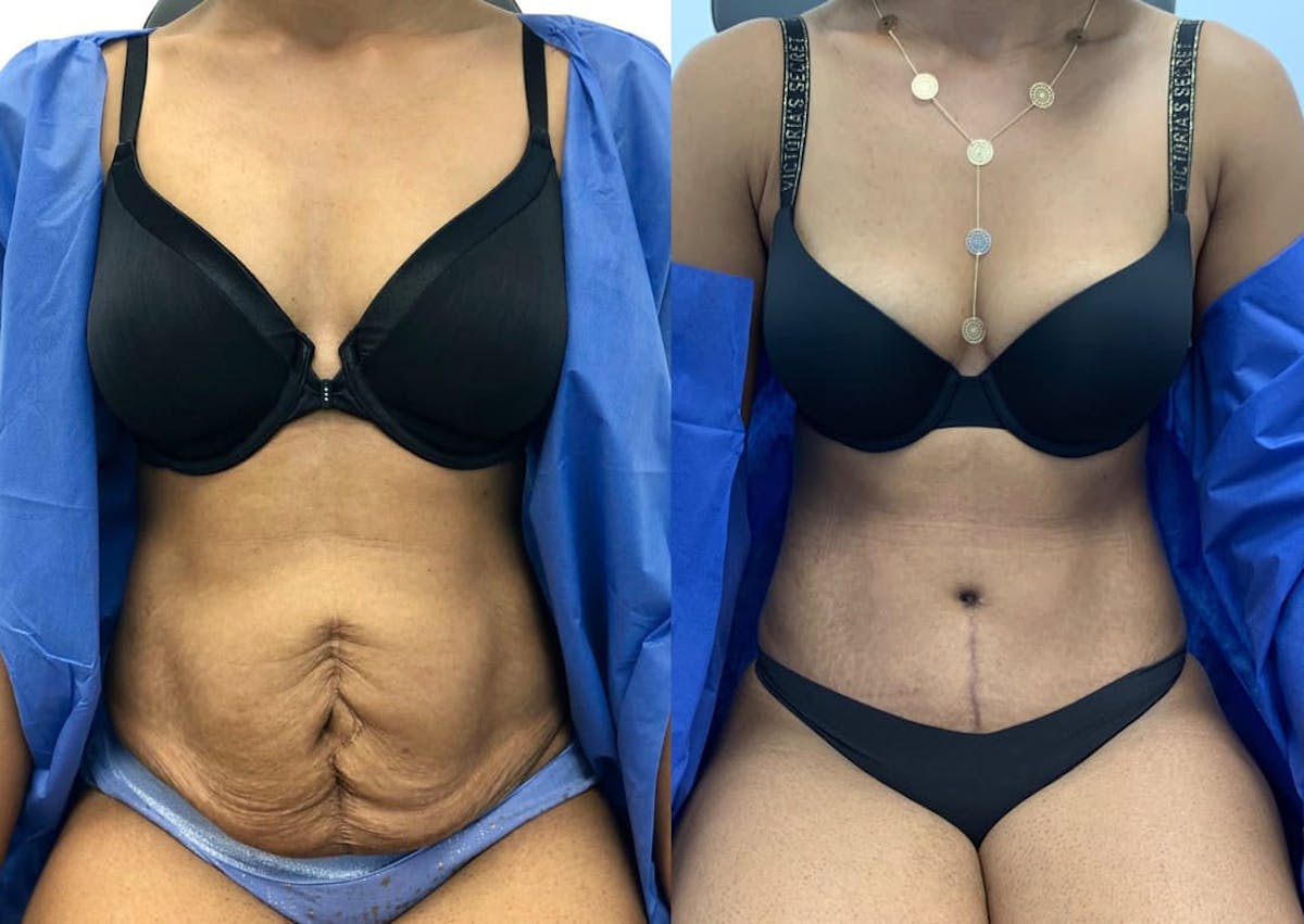 Tummy Tuck Before & After Gallery - Patient 423689 - Image 1