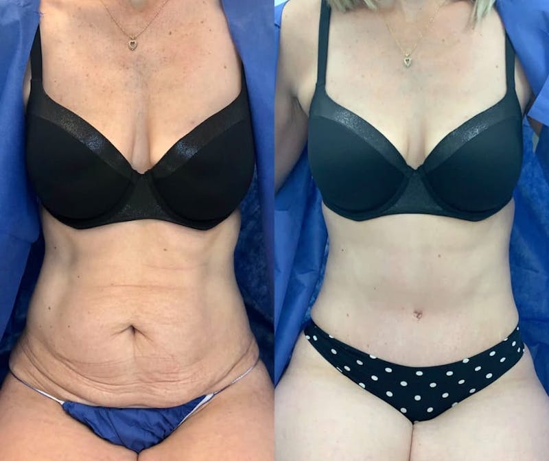 Tummy Tuck Before & After Gallery - Patient 192974 - Image 1