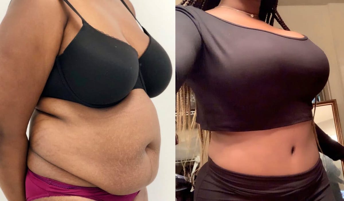Tummy Tuck Before & After Gallery - Patient 109533 - Image 1