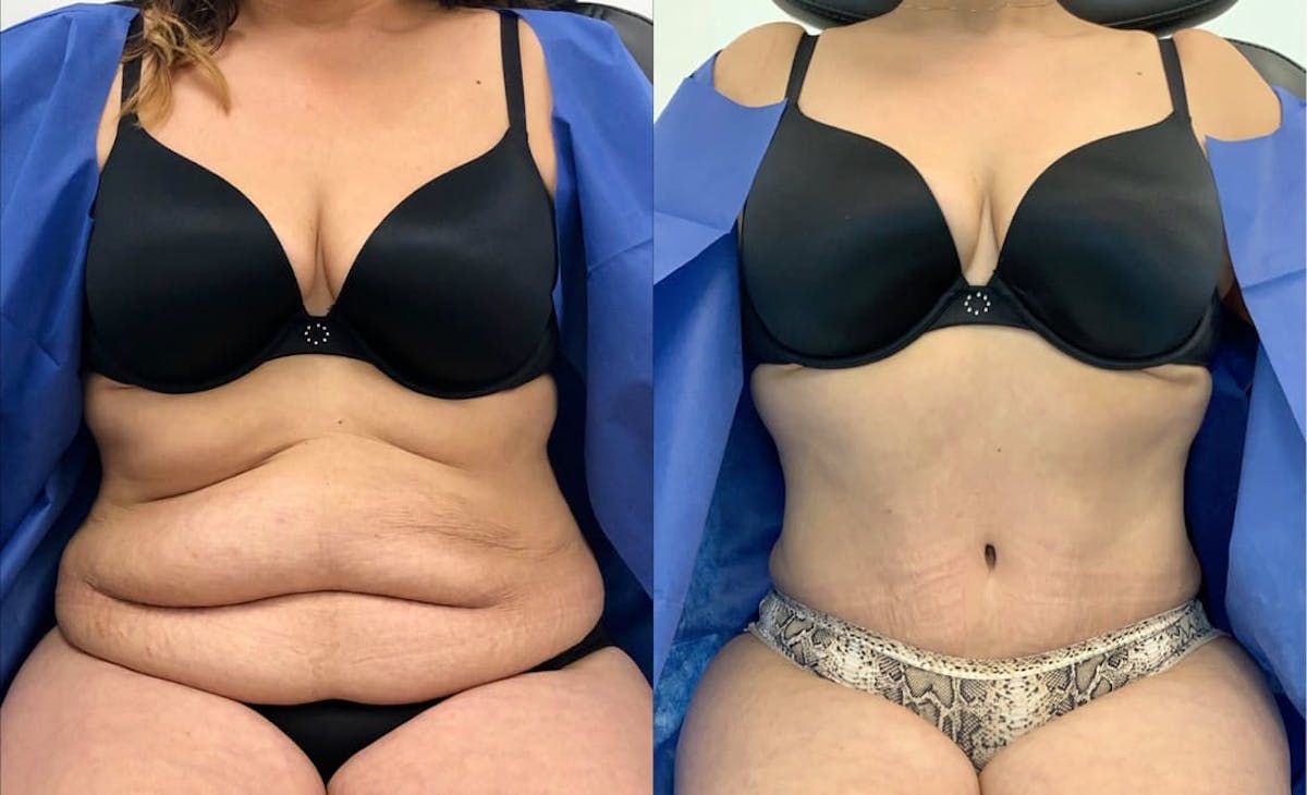 Tummy Tuck Before & After Gallery - Patient 420598 - Image 1