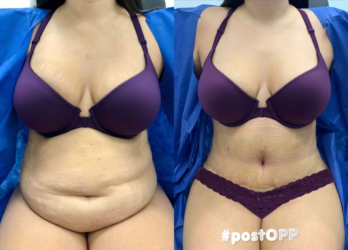 Tummy Tuck Before & After Gallery - Patient 236026 - Image 1