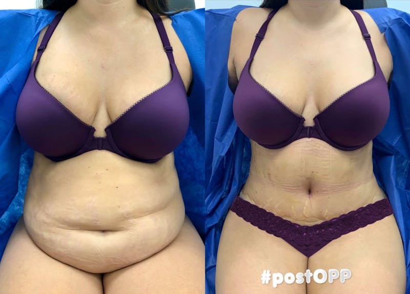 Tummy Tuck Before & After Gallery - Patient 236026 - Image 1
