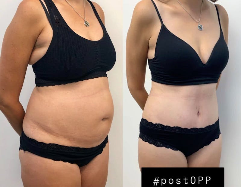 Tummy Tuck Before & After Gallery - Patient 363361 - Image 1
