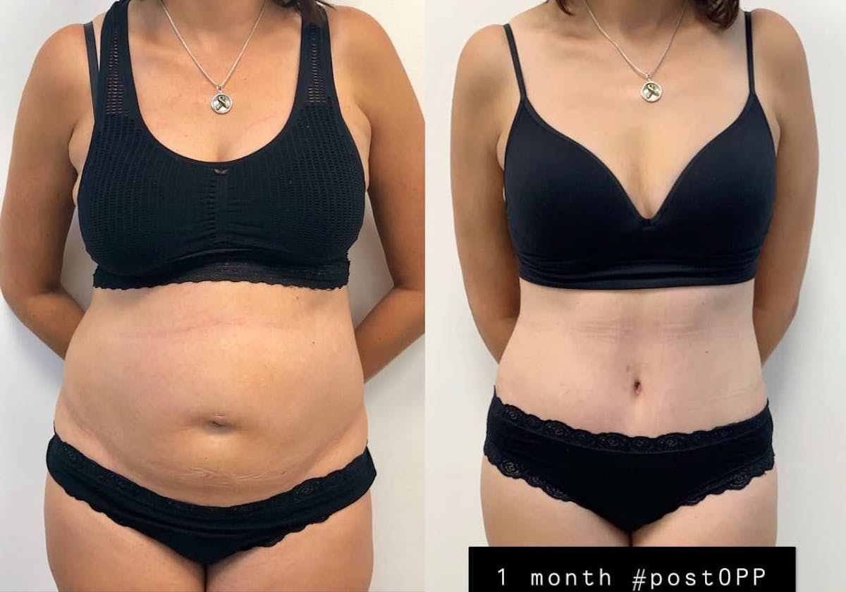 Tummy Tuck Before & After Gallery - Patient 363361 - Image 2