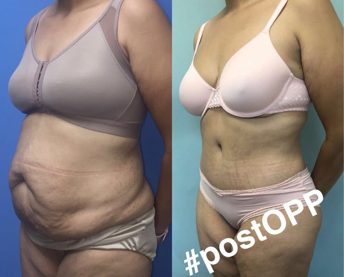 Tummy Tuck Before & After Gallery - Patient 259705 - Image 1