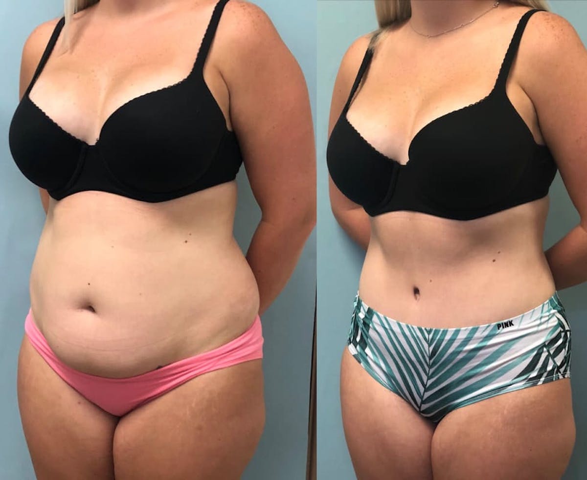 Tummy Tuck Before & After Gallery - Patient 407045 - Image 1