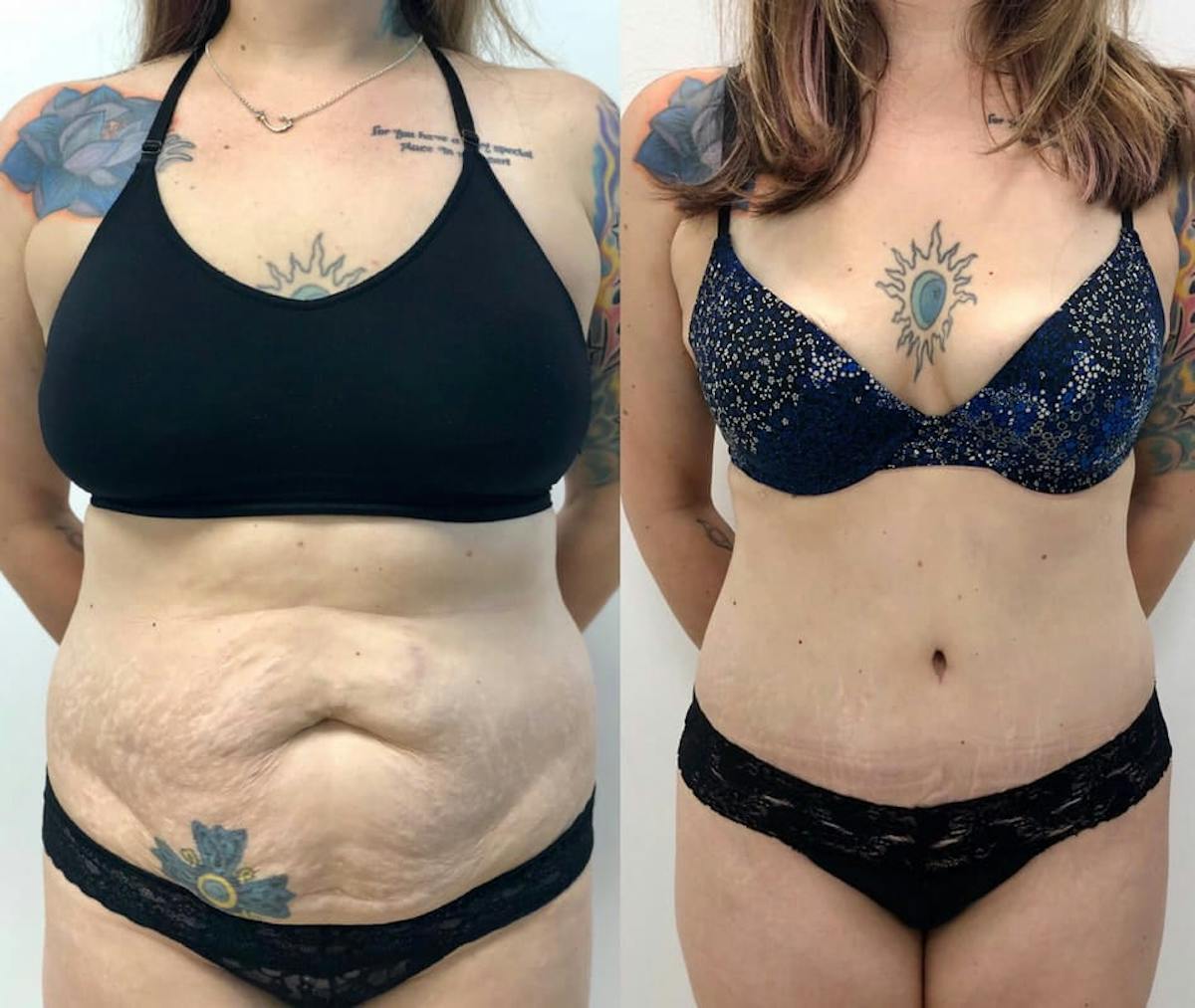 Tummy Tuck Before & After Gallery - Patient 397114 - Image 1
