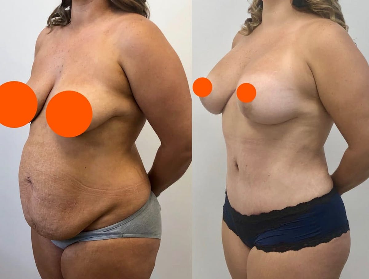 Tummy Tuck Before & After Gallery - Patient 365343 - Image 1