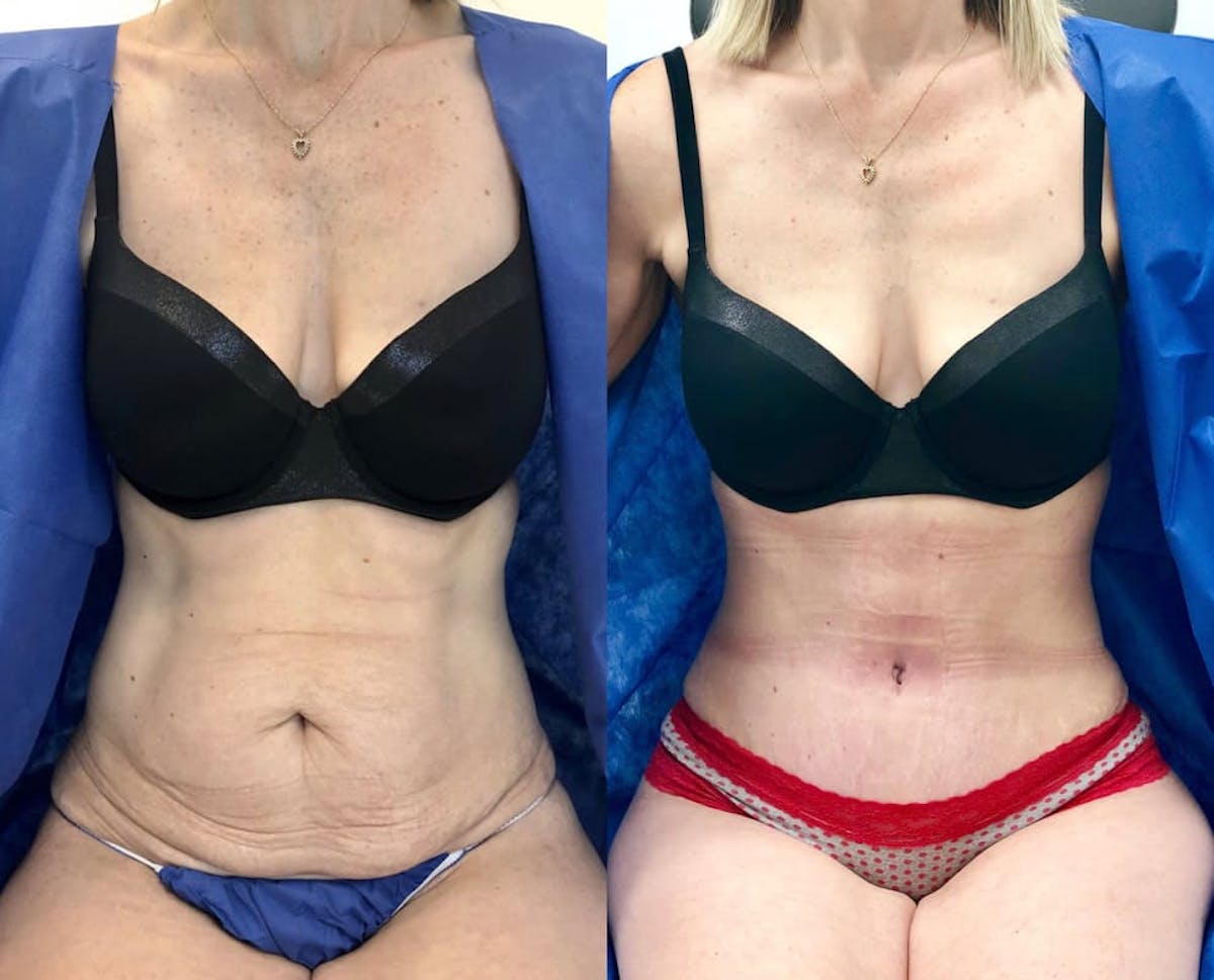 Tummy Tuck Before & After Gallery - Patient 702346 - Image 1