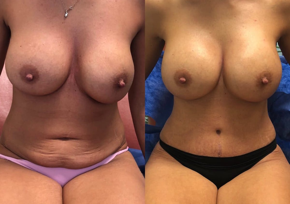 Tummy Tuck Before & After Gallery - Patient 128829 - Image 2
