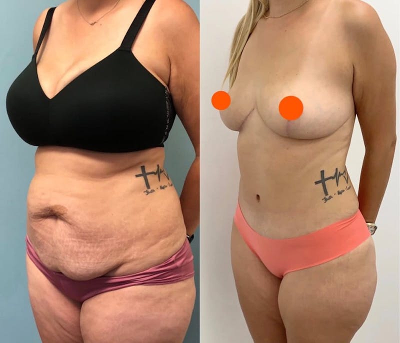 Tummy Tuck Before & After Gallery - Patient 379727 - Image 1