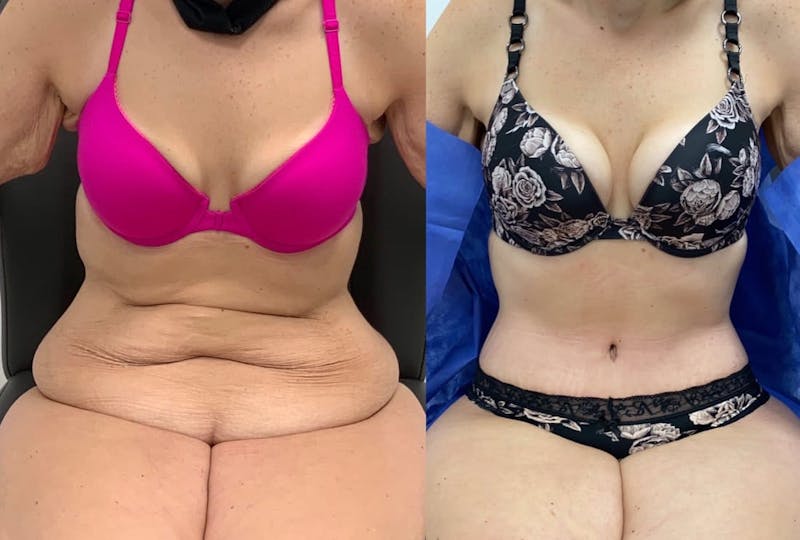 Tummy Tuck Before & After Gallery - Patient 299734 - Image 1