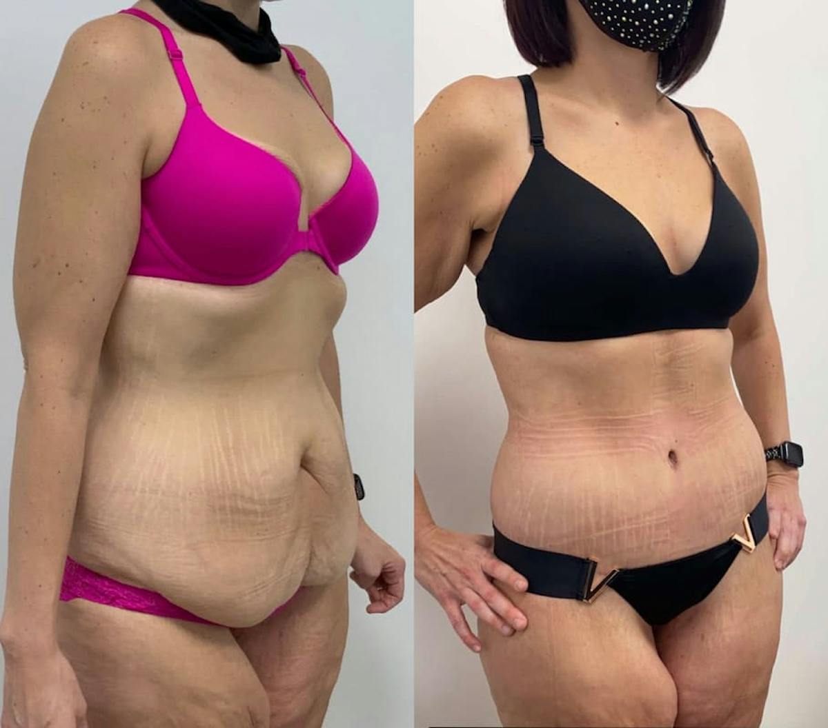 Tummy Tuck Before & After Gallery - Patient 113554 - Image 1