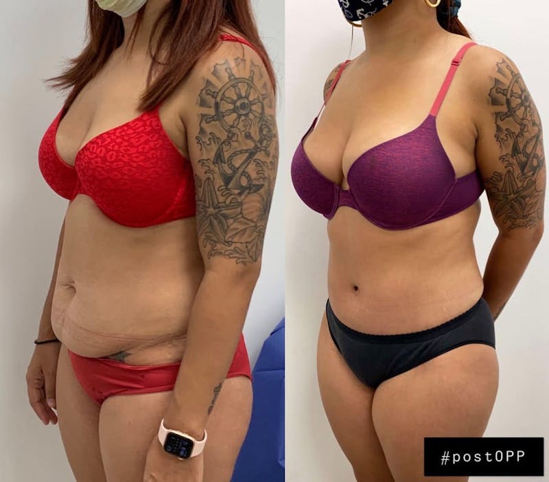 Tummy Tuck Before & After Gallery - Patient 346300 - Image 1