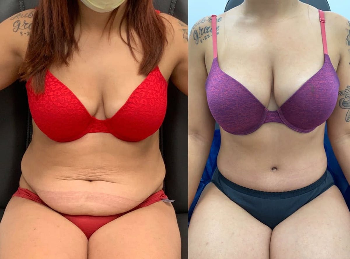 Tummy Tuck Before & After Gallery - Patient 346300 - Image 3