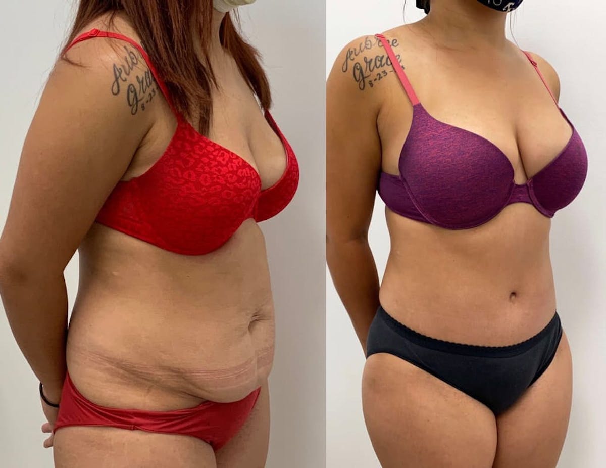 Tummy Tuck Before & After Gallery - Patient 346300 - Image 4