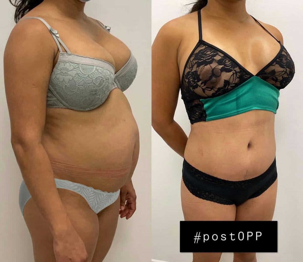 Tummy Tuck Before & After Gallery - Patient 731903 - Image 1