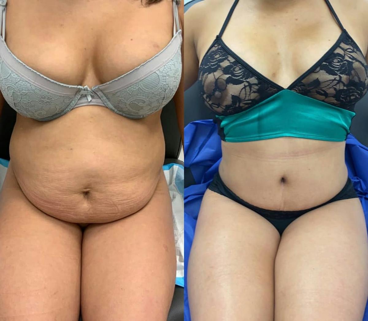 Tummy Tuck Before & After Gallery - Patient 731903 - Image 2