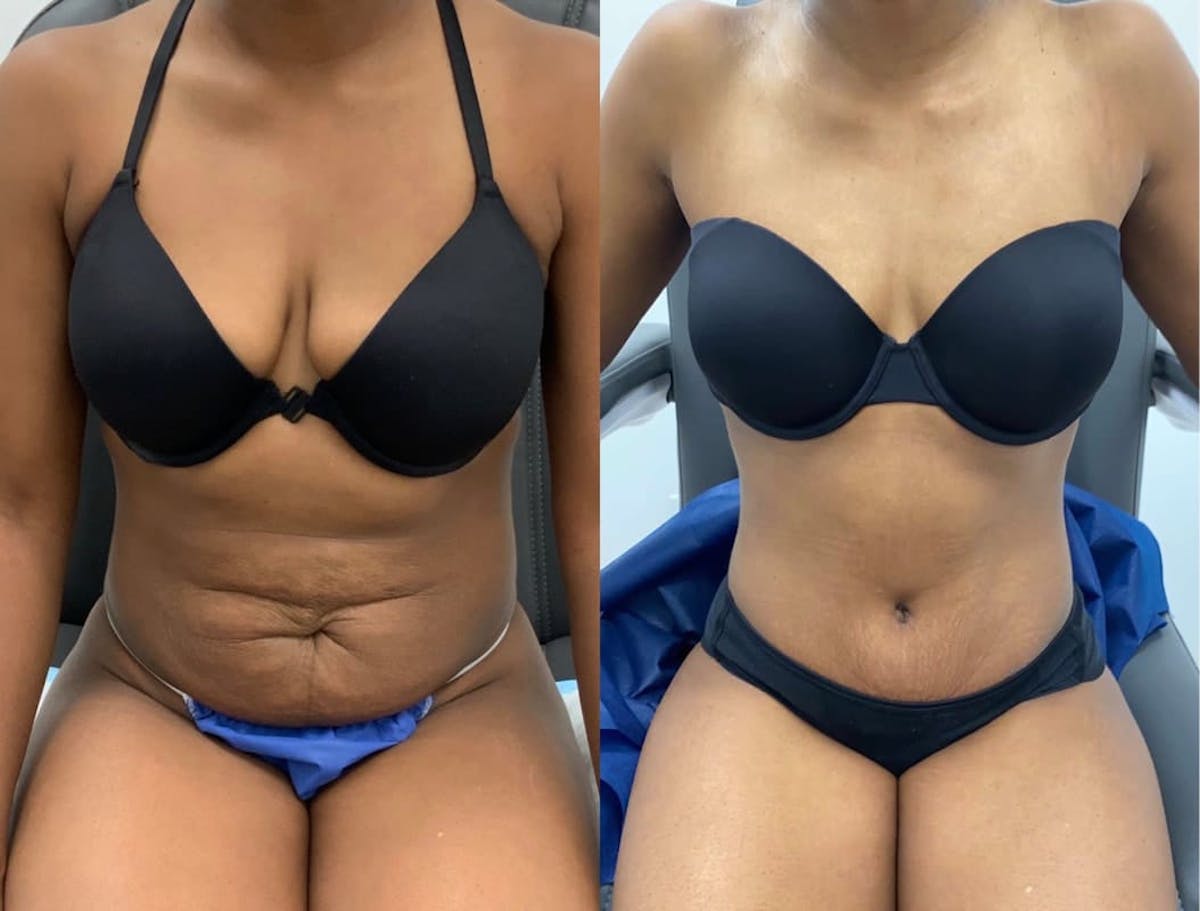Tummy Tuck Before & After Gallery - Patient 419802 - Image 1