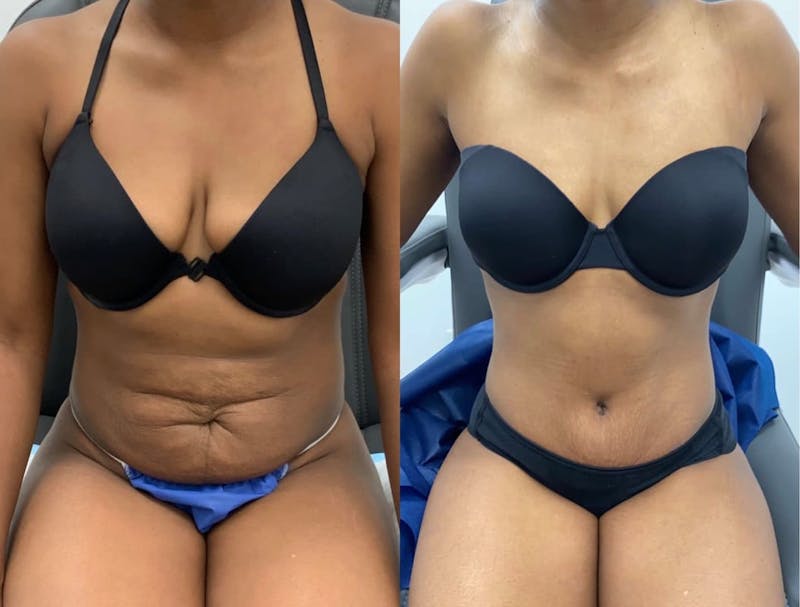 Tummy Tuck Before & After Gallery - Patient 419802 - Image 1