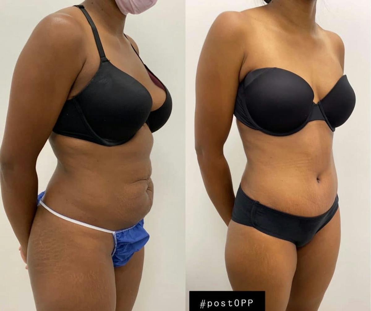 Tummy Tuck Before & After Gallery - Patient 419802 - Image 2