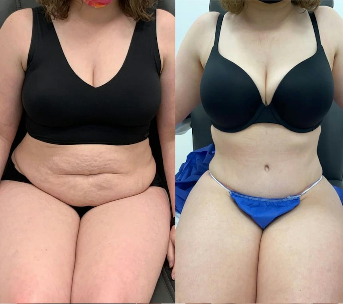 Tummy Tuck Before & After Gallery - Patient 398305 - Image 1