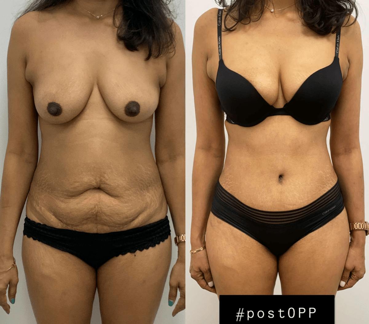 Tummy Tuck Before & After Gallery - Patient 247884 - Image 1