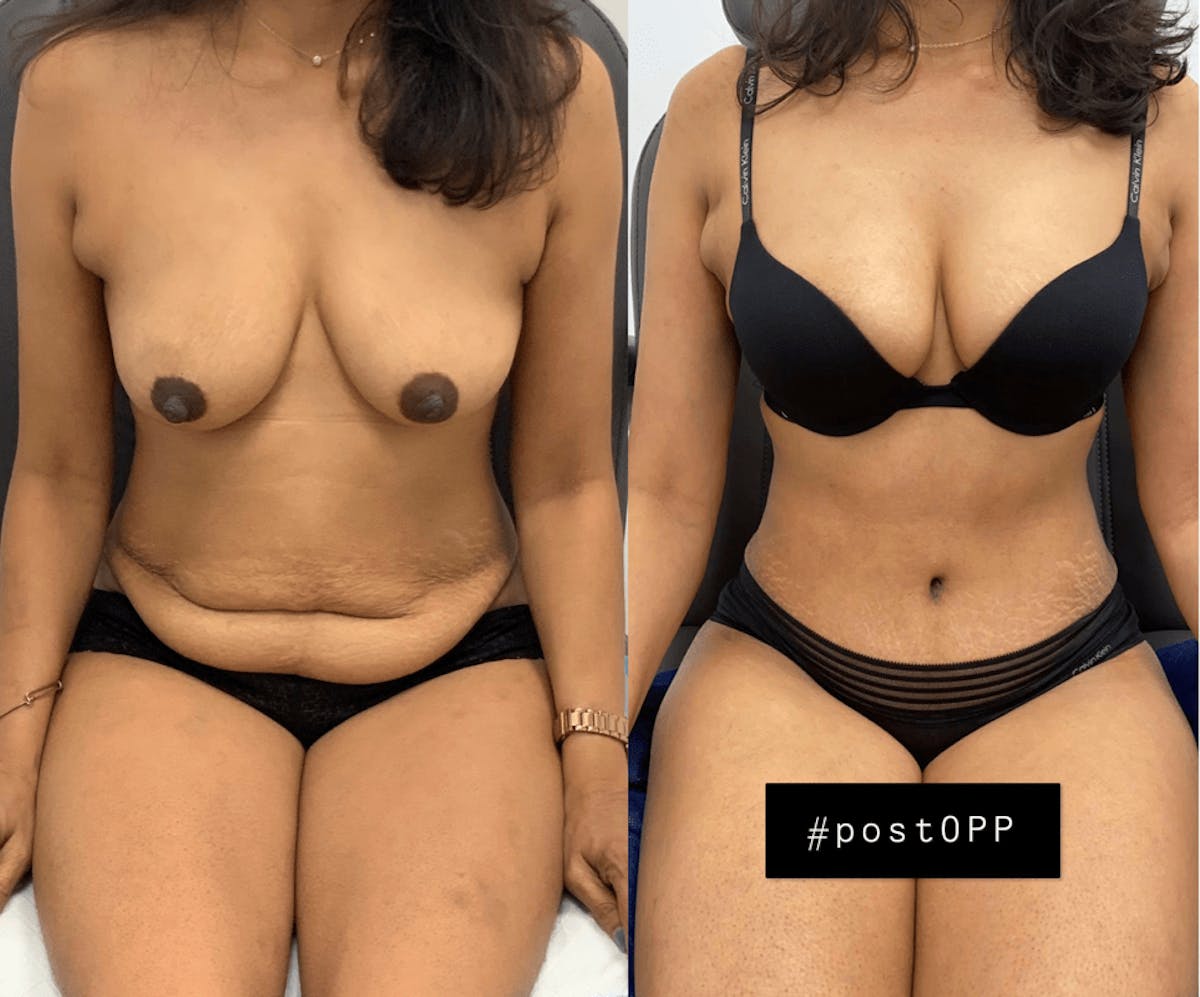 Tummy Tuck Before & After Gallery - Patient 247884 - Image 2