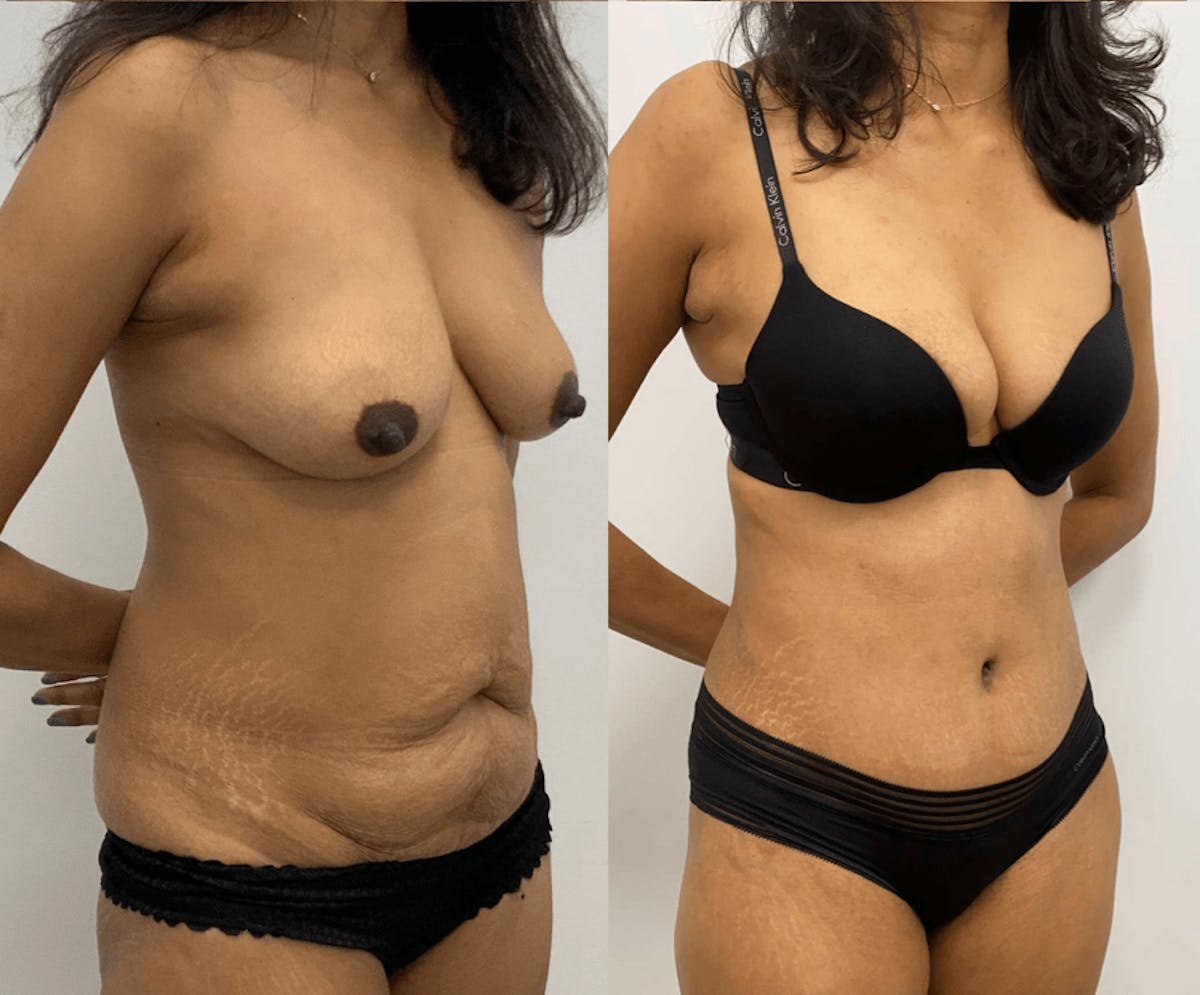 Tummy Tuck Before & After Gallery - Patient 247884 - Image 3