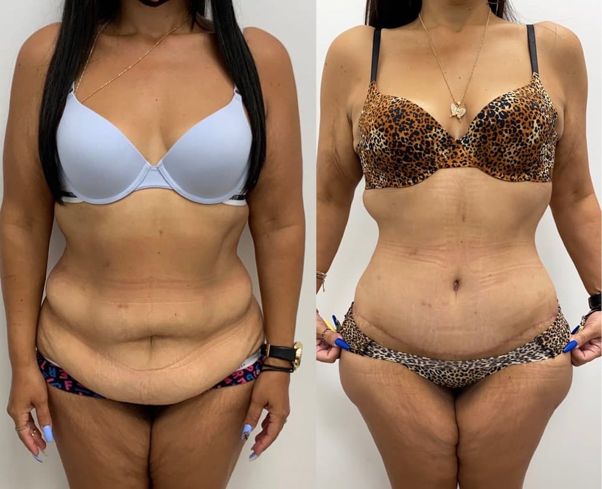 Tummy Tuck Before & After Gallery - Patient 238985 - Image 1