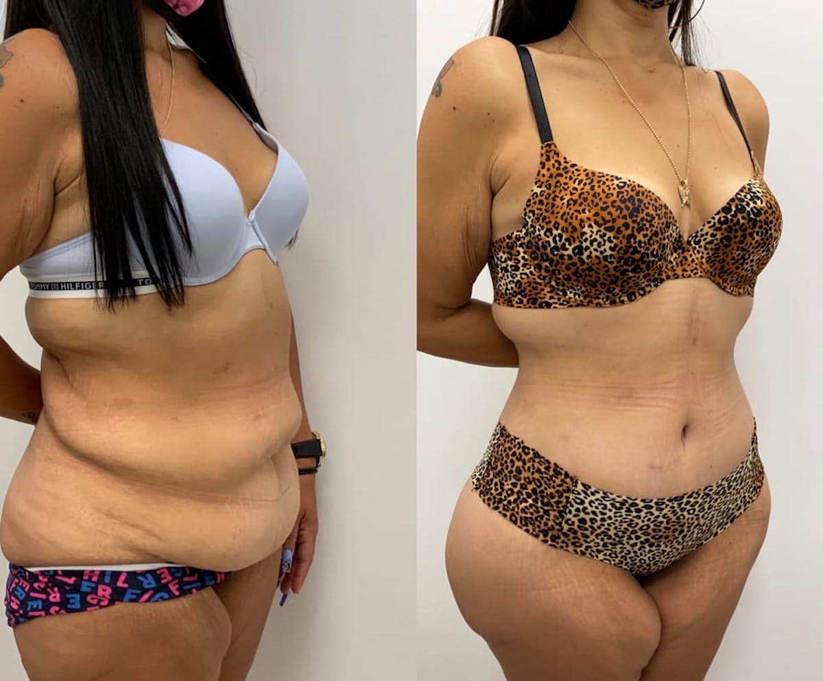 Tummy Tuck Before & After Gallery - Patient 238985 - Image 2